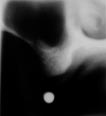 Røntgenundersøgelse S N A B Fig. 5. Eksempler på frontale tomogrammer med 4 mm mellemrum. A: Snitserie fra h. side af overkæben.