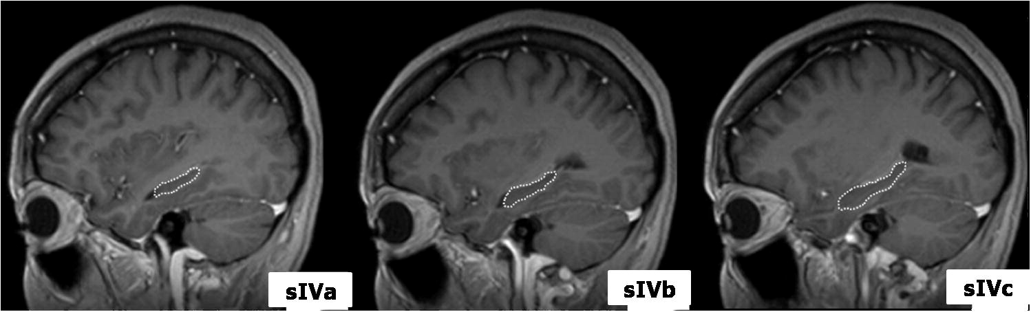 Region of the hippocampus on sagittal T1 weighted