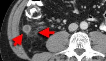 Colon følges proximalt. Se efter Urent fedt (lysegråt) omkring colon diverticulit, appendicit eller tumor.