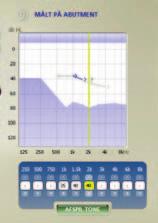 BC in-situ Audiometri Brug værktøjet BC in-situ Audiometri for at måle benledningshøretærsklen via Ponto-høreapparater. Hvornår skal BC in-situ Audiometri anvendes?