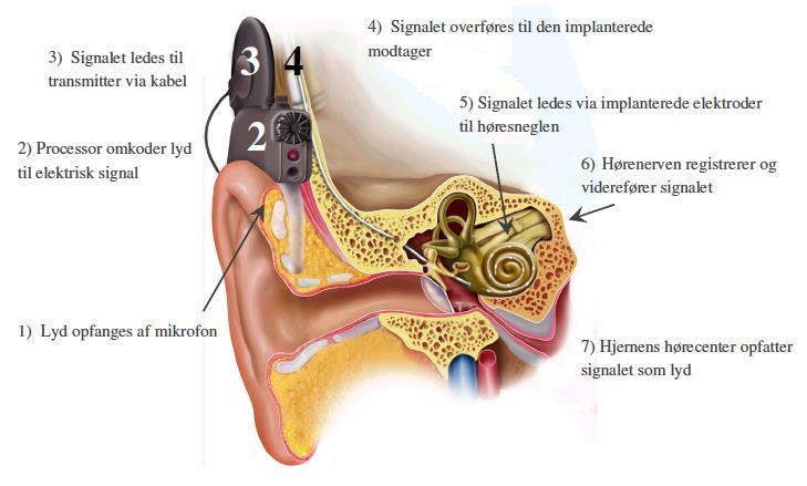 Figur 1. Funktionen af et cochlear implantat. Figuren er fra Sundhedsstyrelsen (2012).