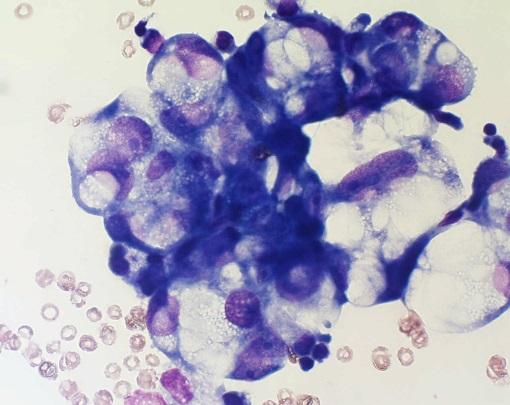 13 I et sygt cellebillede af serøse væsker ses der også mesothelceller dog vil der ved en akut inflammation også ses mange neutrofile granulocytter, pus, bakterier, få makrofager og lymfocytter i