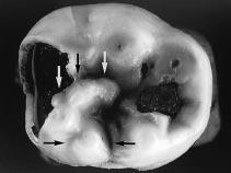 Note also the distinct deflecting wrinkle. B Fig. 6. A: Dansk temporær 2. molar fra højre side af underkæben; okklusalt aspekt. Lodrette pile peger på den vinkelbøjede crista, deflecting wrinkle.