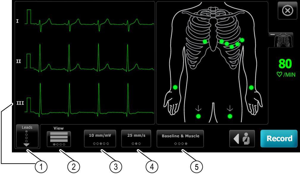 8 EKG-test CP 150 hvile-elektrokardiograf med 12 afledninger Kommentarer. Tryk på OK. 5. Fastgør afledningerne på patienten. 6.