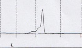 Referencekurve (sort) lægges over andre elektroferogrammer fremkommet ved CZ af prøve