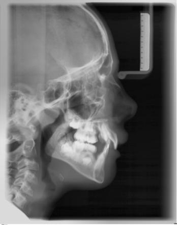 Sirona Dental Systems GmbH Brugsanvisning ORTHOPHOS SL 2D / 3D 5 Betjening 5.1 Oprettelse af røntgenoptagelse 5.1.2.5.1.3 C3 optagelse, lateral Ved denne optageteknik vises en integreret metalskala i næsestøtten på røntgenoptagelsen.