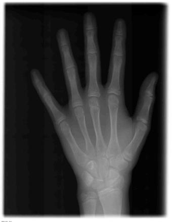 5 Betjening Sirona Dental Systems GmbH 5.1 Oprettelse af røntgenoptagelse Brugsanvisning ORTHOPHOS SL 2D / 3D 5.1.2.5.1.4 C4 håndrodsoptagelse, symmetrisk Programmet viser en håndrodsoptagelse.