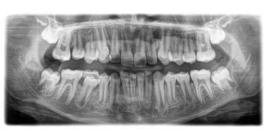 5 Betjening Sirona Dental Systems GmbH 5.1 Oprettelse af røntgenoptagelse Brugsanvisning ORTHOPHOS SL 2D / 3D 5.1.2.1.1.3 P10 panoramaoptagelse til børn Optagelsen viser et reduceret tandområde uden opstigende forgreninger.