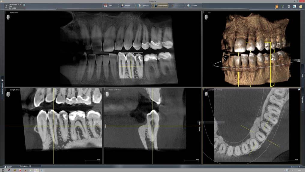 5 Betjening Sirona Dental Systems GmbH 5.1 Oprettelse af røntgenoptagelse Brugsanvisning ORTHOPHOS SL 2D / 3D 5.1.2.4.1.2 VOL2 HD / VOL2 SD / VOL2 Low Via Easypad kan der vælges en af den fem volumenområder: Fortandsområde overkæbe eller underkæbe Præmolar- hhv.