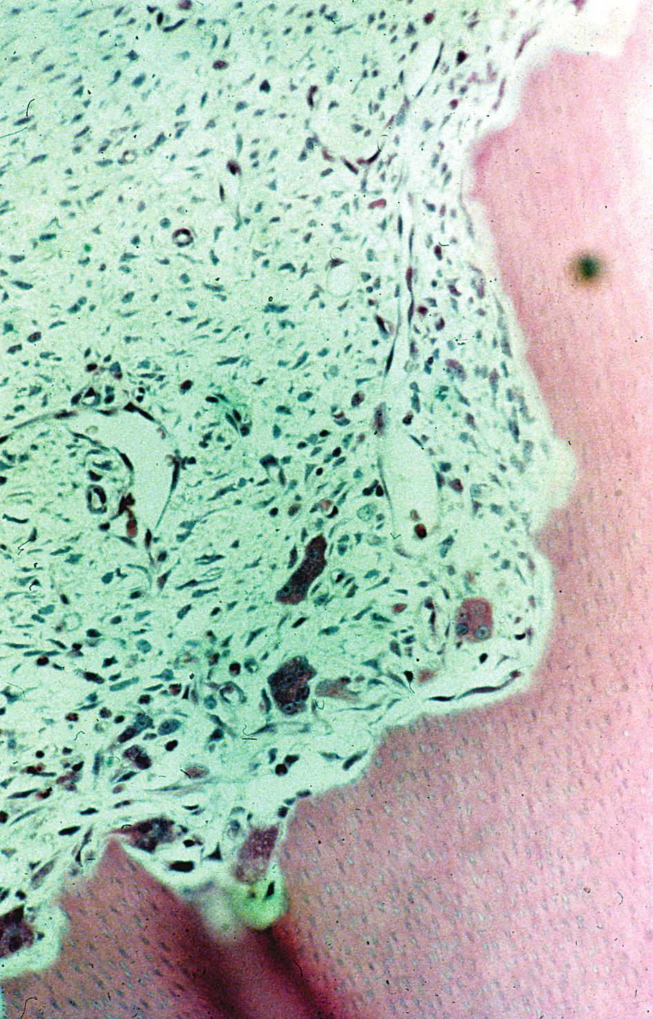 B: The root surface is re sorbed by multinuclear clast-like cells along an irregular dentin surface (LM).