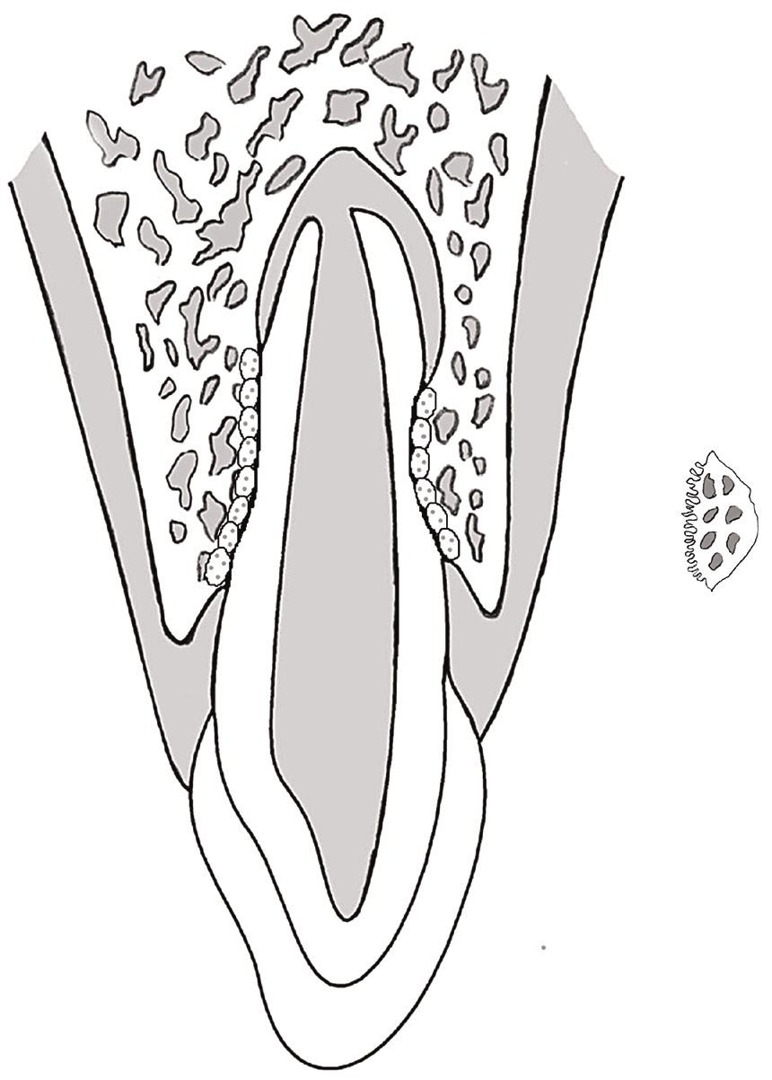 Resorption af tandsubstans Fig. 5. Hvis cellerne på tandoverfladen, cementoblaster eller odontoblaster, er gået tabt, kan cellerne af gode grunde ikke levere osteoprotegerin.