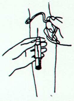 Vær opmærksom på at holde kanylen i ro, da det er ubehageligt for patienten, hvis den bevæges i venen. Næste prøveglas kan nu fyldes på samme måde.