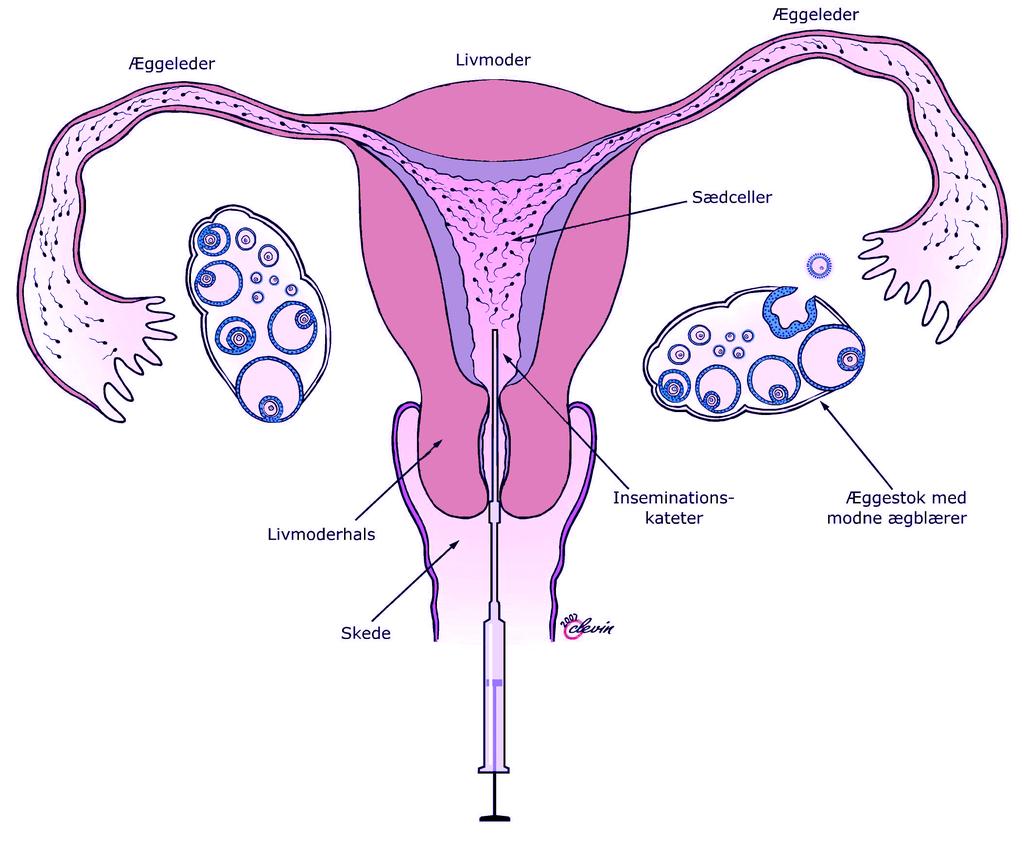 Kvinden Er kvindens livmoderslimhinde meget tynd, har hun uregelmæssige menstruationer eller udeblivende ægløsning, kan hun hjælpes med hormonbehandling og insemination.