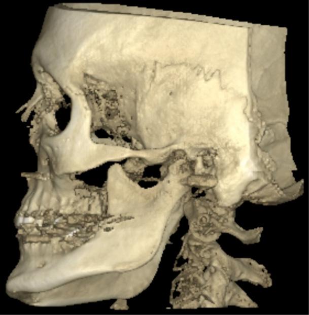 Højre processus condylaris fremstår med øget knoglemængde, som fortsat er i vækst. Der er ligeledes øget knoglemasse i basis mandibulae i højre side.
