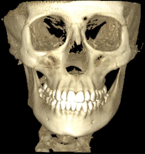 Særligt karakteristisk for HH er, at ramus og corpus mandibulae er involverede, hvilket resulterer i en øget afstand mellem tandrødderne og canalis mandibularis (7).