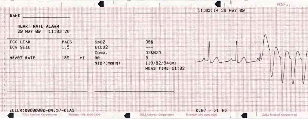 Oversigtsrapport Format for aktiveret hjertefrekvensalarm Oversigtsrapportfunktionen registrerer patientens EKG i 6 sekunder inden alarmen.