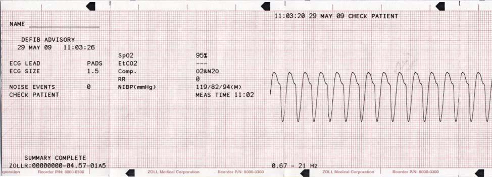 Den dato/det klokkeslæt, der udskrives øverst på strimmelen, svarer til de EKG-data, som udløses 6 sekunder før starten af EKG-strimmelen.