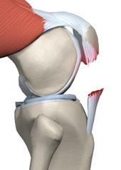 1 Underben Udisloceret: CT-scanning og vurdering og evt. konservativ behandling med knæ-hængsel bandage i 8-12 uger. Instruktion i isometriske quadriceps-øvelser. Klinisk og rtg.