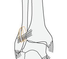 F. distalis tibia (intraartikulær = Pilon) Indlæggelse til osteosyntese forudgået af