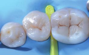 myring Forte provides excellent matrix retention; Along with mywedge, it adapts nicely to the gingival contour, while