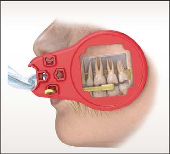 Placér sensoren i patientens mund, og justér den parallelt med