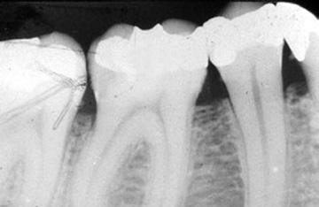 Røntgenbilleder kan vise, hvor fremskreden sygdommen er. Hvem rammes af parodontitis? Det øverste røntgenbillede viser tænder med normalt fæste, og det nederste viser tænder med fæstetab.