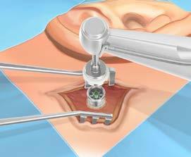 22) Placer implantatet aksialt på linje med hullet og begynde at indsætte implantatet. Start overbrusning når den yderste del af gevindet er i kontakt med knoglen. (Fig.