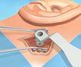 (Fig. 24) 21 22 Ettrins-kirurgi Vigtigt Drejningsmoment Når flangen på implantatet har nået knogleoverfladen, stopper den automatisk.