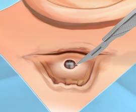 Trin 6 Udstansning af hul og suturering Udstans et hul lige over abutmentet ved hjælp af en biopsypunch (Ø4 mm Ø5 mm). (Fig. 26) Træk huden forsigtigt over abutment.