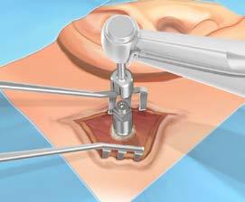 2) Placer implantatet aksialt på linje med hullet og begynde at indsætte implantatet. Start overbrusning når den yderste del af gevindet er i kontakt med knoglen. (Fig.