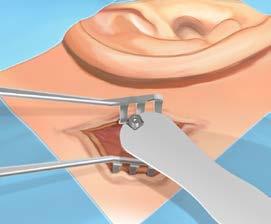 Trin 6 Placering af cover screw Anbringelse af en cover screw er vigtig for at forhindre at knoglen vokser ind over implantatflangen, i abutmentgrænsefladen på implantatet eller potentielt ind i det