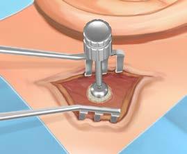 Skru cover screw på implantatet. (Fig. 7) Vigtigt Cover screw Undgå at over-stramme cover screw, da dette kan løsne implantatet, når man løsner cover screw i anden fase af proceduren.
