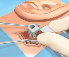 Andet trin I anden fase kan reduktion af væv udføres/ikke udføres, afhængigt af valgte teknik og den første fase. Cover screw fjernes, og abutmentet forbindes til implantatet.