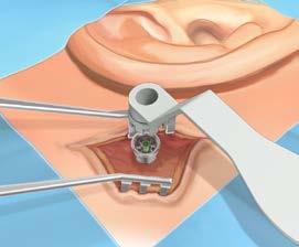 Vigtigt Undgå øget belastning på implantatet Brug altid counter torque wrench når centrumskruen til abutmentet slækkes eller strammes og hold den i en stabil position.