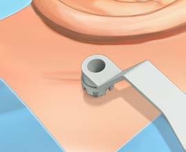 1) Frigør abutmentet fra implantatet ved hjælp af håndtaget med skruetrækkeren og skru centrumskruen ud. (Fig. 2) Fjern skrue og abutment. Fjern abutmentet fra counter torque wrench og kassér skruen.