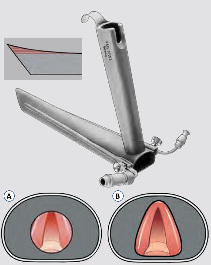 Anterior commissure laryngoskop - Spidsens trekantede form optimerer indblik til commisura anterior - Alternativ 1.