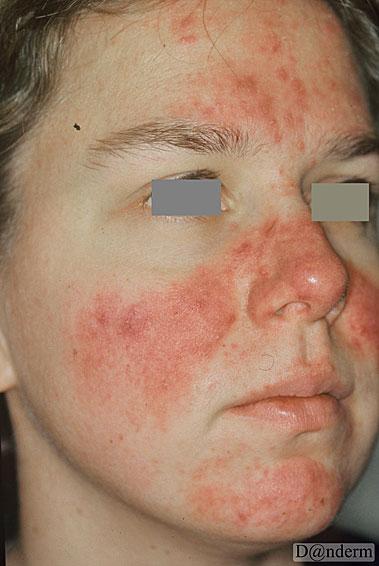 3. 32-årig tidligere hudrask kvinde med kløende og prikkende udslæt i ansigt igennem 1 måned.