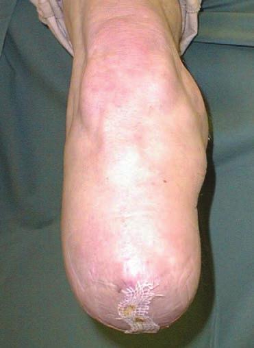 Medicinering med diuretika FORSLAG TIL AFHJÆLPNING Iceross-lineren skal anvendes så ofte som muligt, selv når protesen ikke er på.