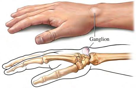 Seneknuder på hånd og fingre Seneknuder på hånd og fingre kaldes også ganglion. Seneknuden er godartet, fyldt med væske og sidder ved en ledkapsel eller seneskede.