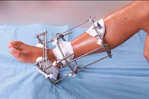 Kan man sove med sådan et apparat på benet? Kvalitativ undersøgelse af ortopædkirurgiske patienters erfaringer med at sove og mestre forløbet med eksternt fiksationsapparatur Figur 1.