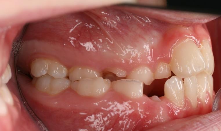 Dentitions og okklusionsudvikling - PDF Gratis download