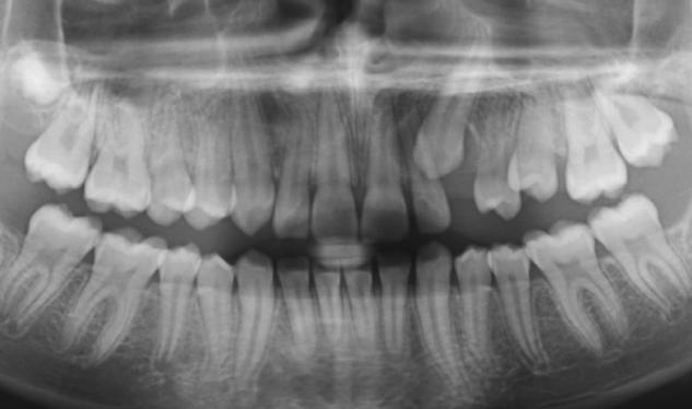 Herefter laves to parallelle vertikale aflastningssnit, så lappen kan forskydes i apikal retning, og kronen på den retinerede tand blotlægges.