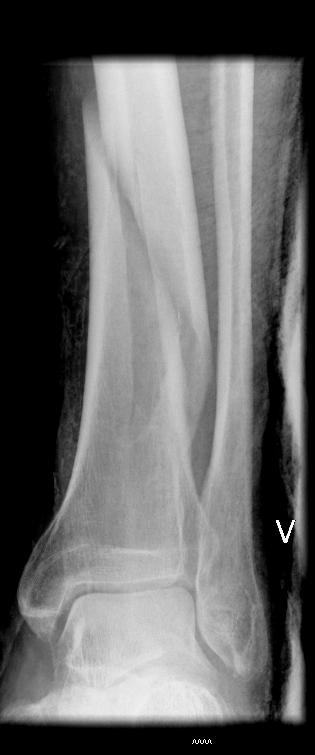 fracture Soft tissue is normal X-ray