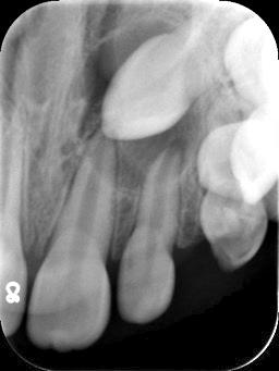 T videnskab & klinik oversigtsartikel Forstørret tandfollikel på +3 Ekstern rodresorption på 2+ Fig. 6. Billedet viser en forstørret tandfollikel samt ektopisk lejret +3 på en 11-årig pige.