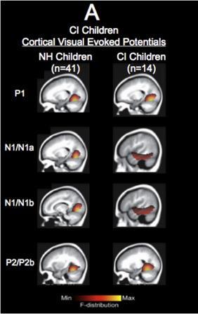 Visuel re-organiserings plasticitet hos børn med CI Billeder viser børns neurale svar på en visual stimulation hos børn med normal hørelse og børn med høretab/ci.