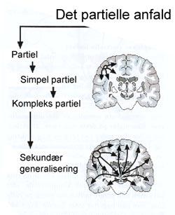 Typer af epilepsi. Epilepsianfald kan være meget forskellige alt efter hvor i hjernen det går galt. Man kan dele epilepsi op i to hovedgrupper Partielle anfald og Generaliserede anfald 4.