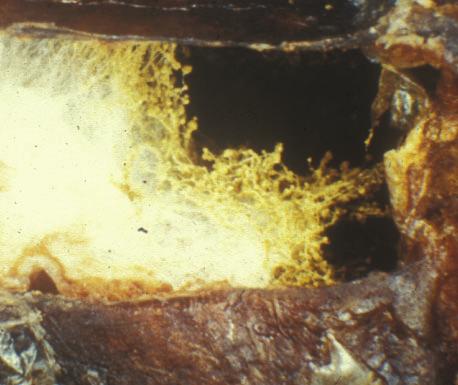 Til sidst vokser myceliet ud gennem overfladen af bien, hvorefter såkaldte konidiebærere dannes. Konidiebærerne danner og spreder nye sporer som så kan inficere nye bier eller larver.