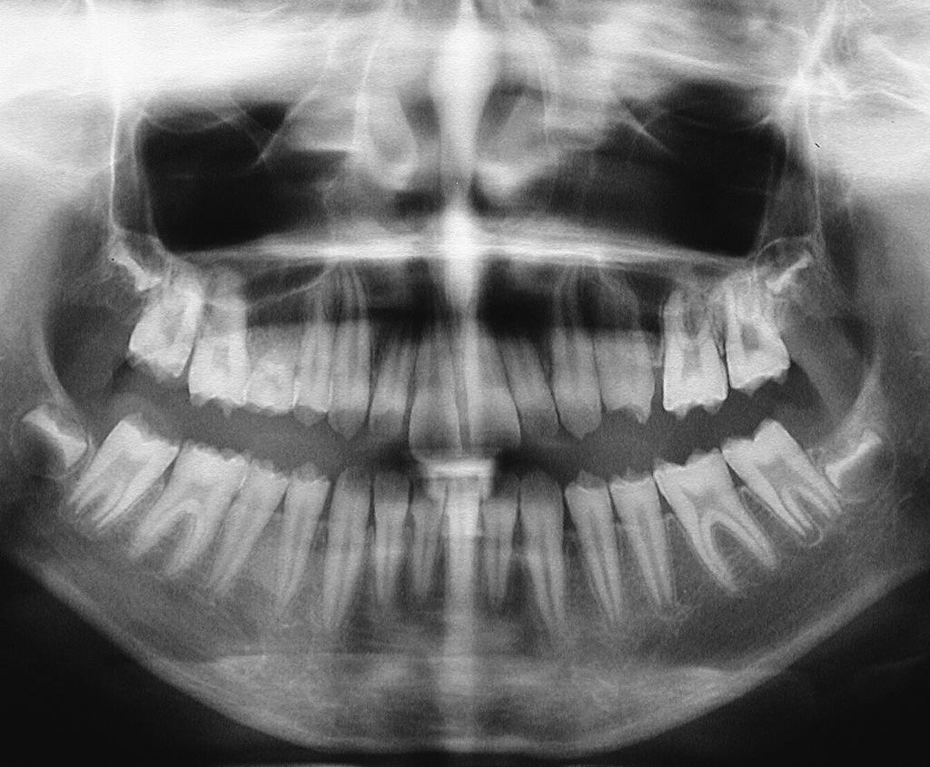 Mineraliseringsforstyrrelser Fig. 6. I hypoplasitype. : Klinisk optagelse af tandsættet. Emaljeoverﬂaden er ujævn, men hård.