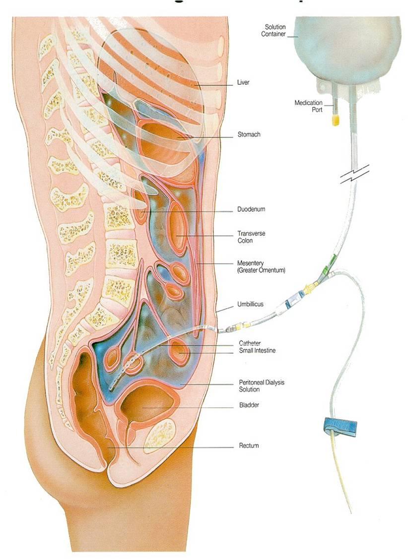 Peritonealdialyse (PD) Via et p-kateter lukkes steril dialysevæske ind i bughulen, hvor peritonæum fungerer som et filter.