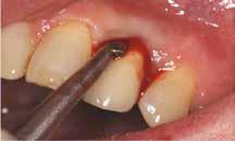 MINVALUX MINVALUX BLACK Brug af MINVALUX-INSTRUMENTER Det er i dag muligt at ekstrahere en tand eller en rod med immediat placering af implantatet, forudsat at indikationerne for proceduren